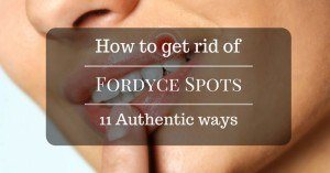 Fordyce Spots
