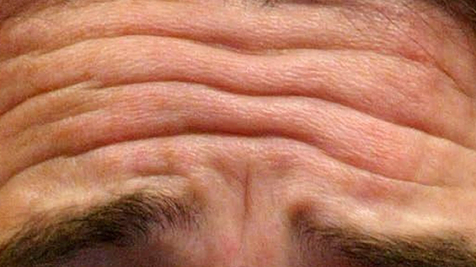 forehead 2