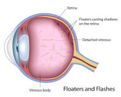 eye floaters 3