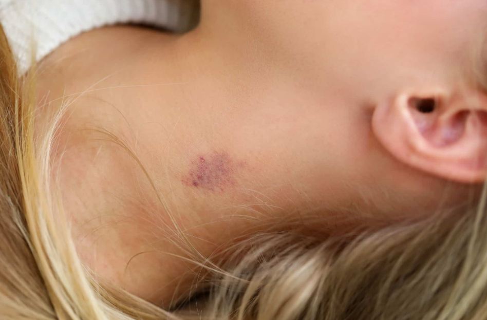 hickey 1 hickey