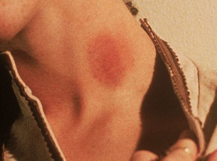 hickey 2 hickey