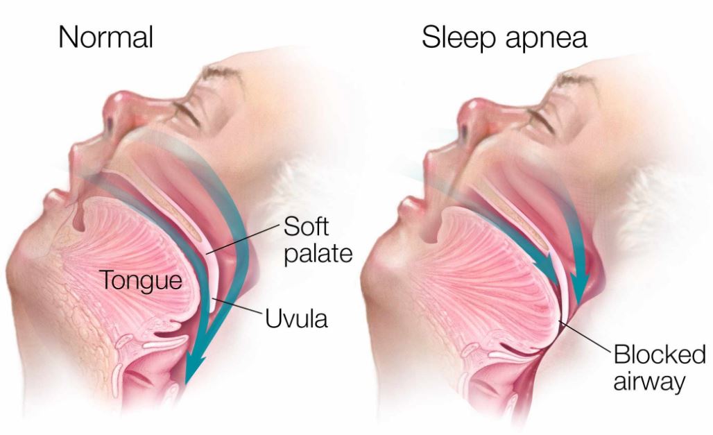 sleep apnea