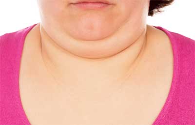 Double-Chin