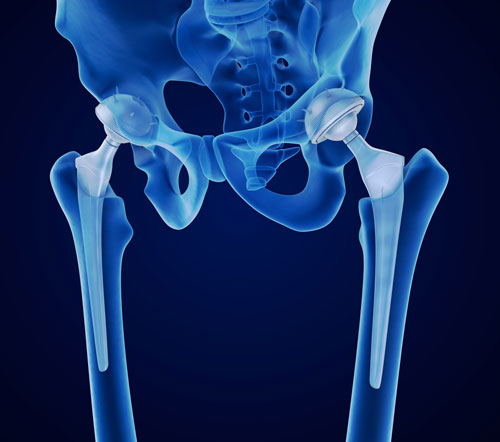 hip implant to get rid of hip dips